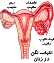 تاثیر بیماری التهابی لگن بر ناباروری