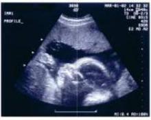  سونوگرافی های غیرضروری به سلامت جنین لطمه می زند