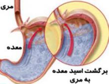 ریفلاکس معده,علایم ریفلاکس معده,درمان ریفلاکس معده,shabnamha.ir,شبنم همدان,afkl ih