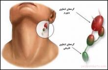 غدد لنفاوی,تورم غدد لنفاوی,درمان متورم شدن غدد لنفاوی,غده لنفی,گره های لنفاوی,shabnamha.ir,شبنم همدان,afkl ih,شبنم ها