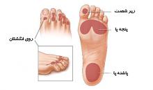 افراد دیابتی,زخم دیابتی,طب فیزیکی,توانبخشی,shabnamha.ir,شبنم همدان,afkl ih,شبنم ها