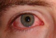 قرمزی چشم,خشکی چشم,حساسیت فصلی,shabnamha.ir,شبنم همدان,afkl ih,شبنم ها