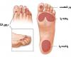 افراد دیابتی,زخم دیابتی,طب فیزیکی,توانبخشی,shabnamha.ir,شبنم همدان,afkl ih,شبنم ها